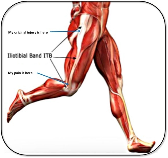 Renne's Test  Iliotibial Band Friction Syndrome ITBS 