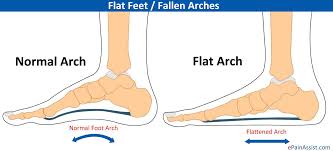 Flat or Flatter Feet | MGS Physiotherapy