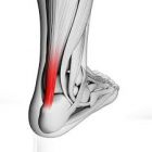 Tendinopathy | MGS Physiotherapy