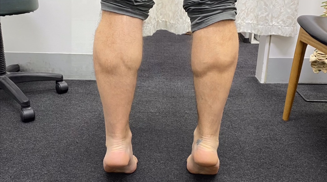 75 Day Calf Tear Recovery 🤯 This was 75 days after a horrible Grade 3